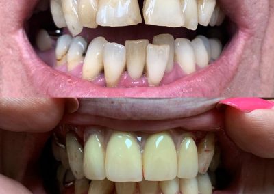 Immediate partial dentures