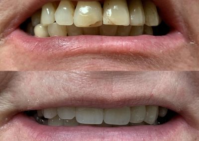 Immediate partial upper and lower dentures