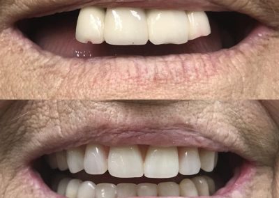 Immediate upper and lower dentures