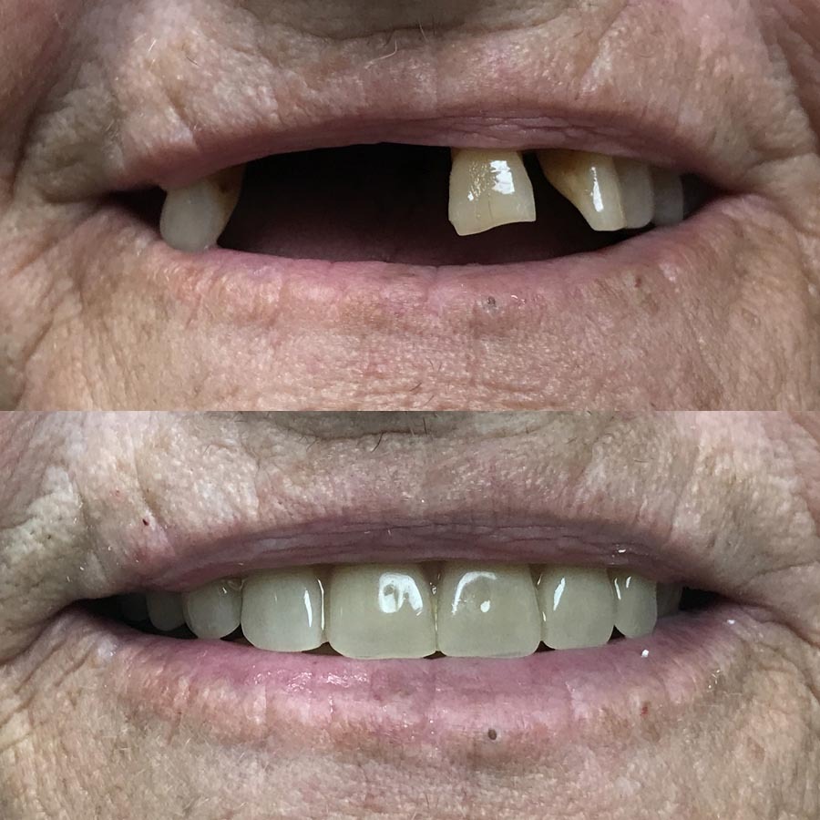 Immediate upper and lower dentures