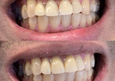 New Partial upper denture