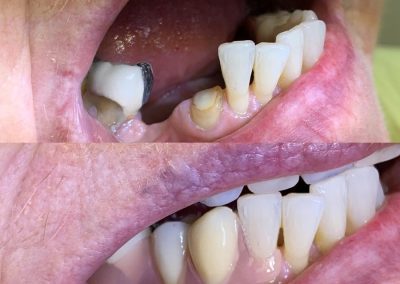 Partial denture with Invisible clips