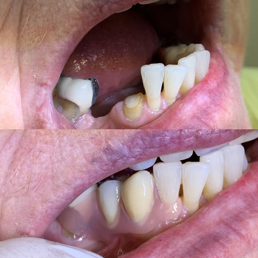 Partial denture with Invisible clips