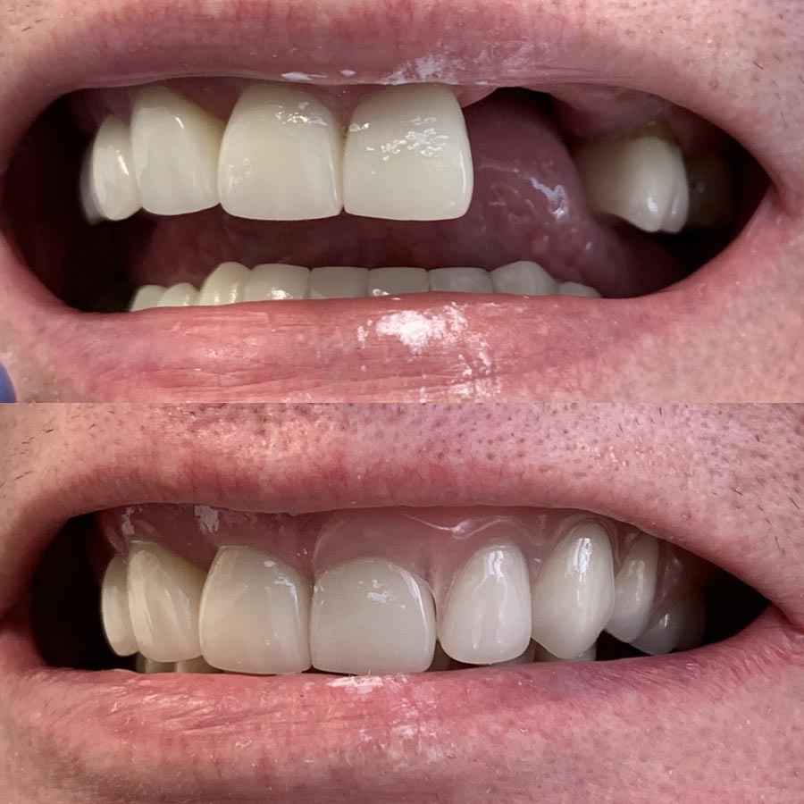 Partial denture with the Invisible clips