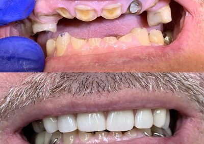 Severely worn teeth restored with Partial dentures