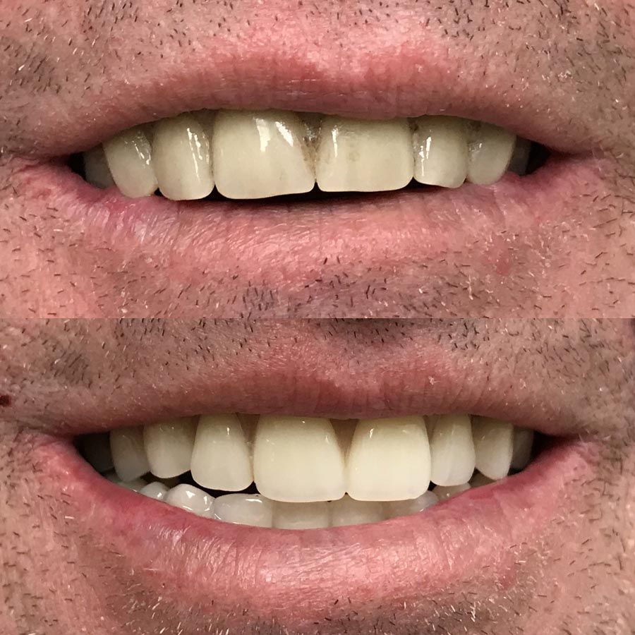 Temporary vs Permanent dentures